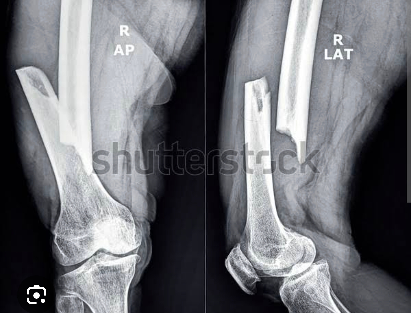 X-ray