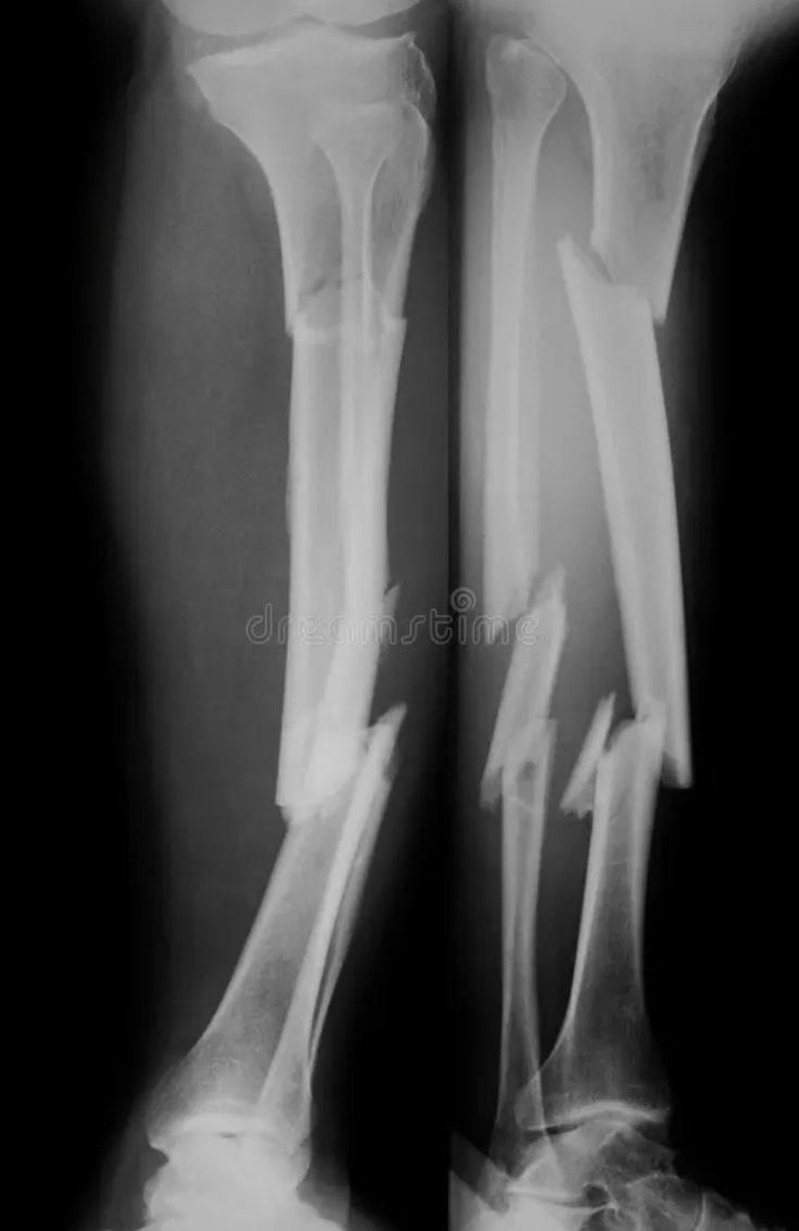 X-ray