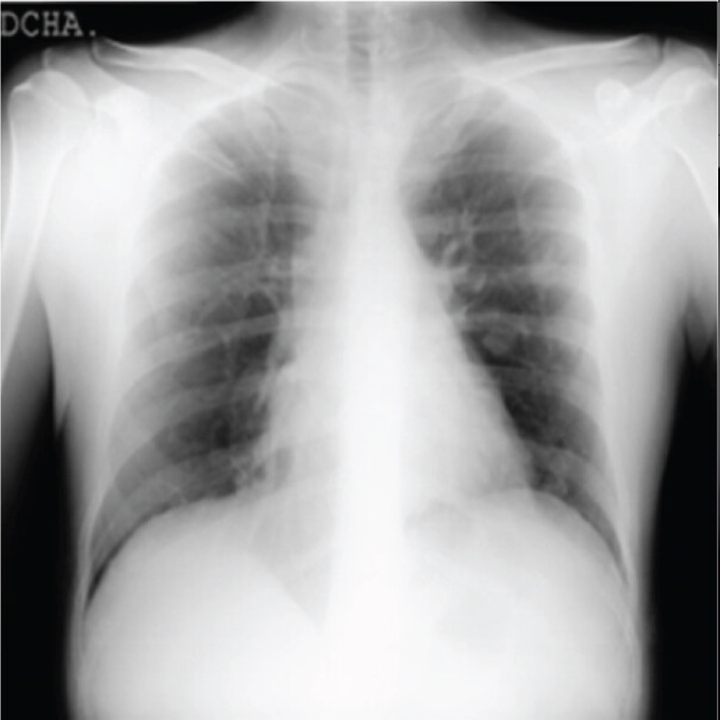 X-ray