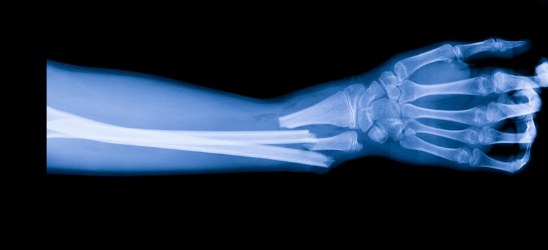 X-ray