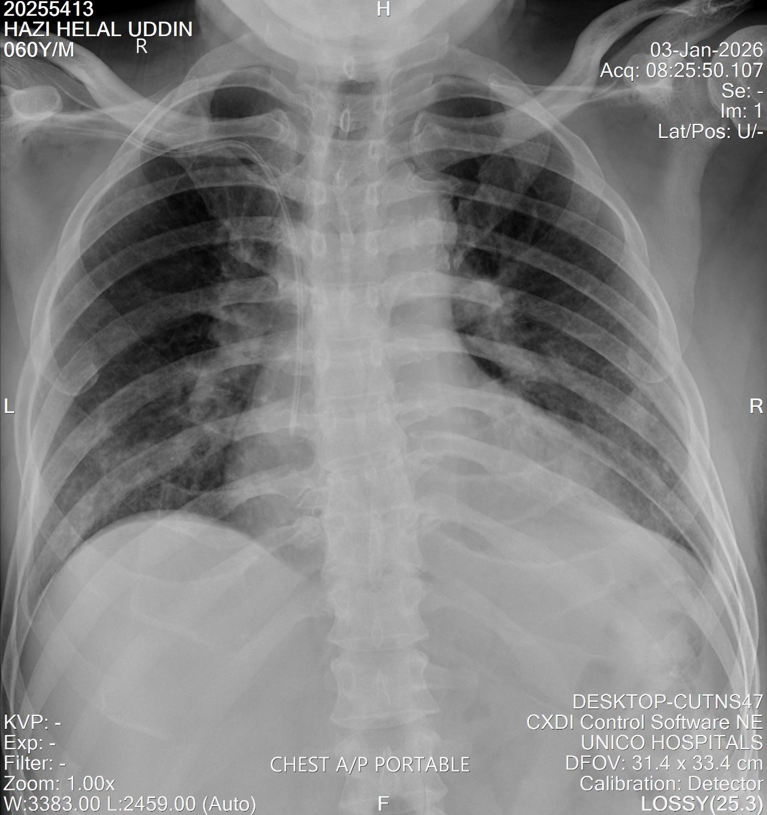 X-ray