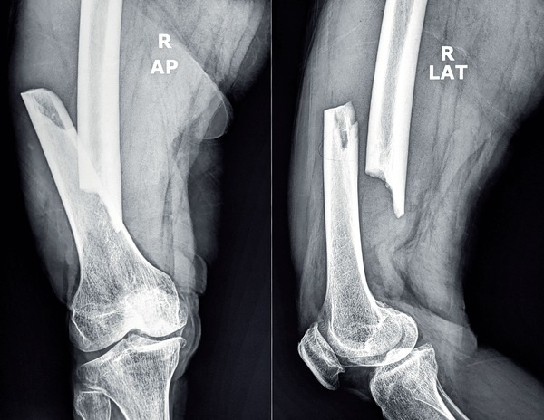 X-ray